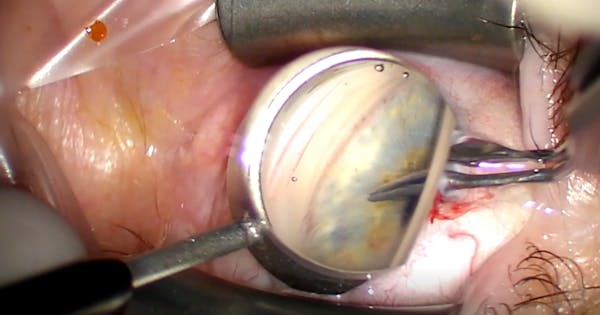 Goniotomy BANG Technique thumbnail