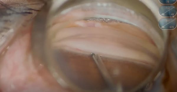 iStent infinite in Eyes With Previous MIGS thumbnail