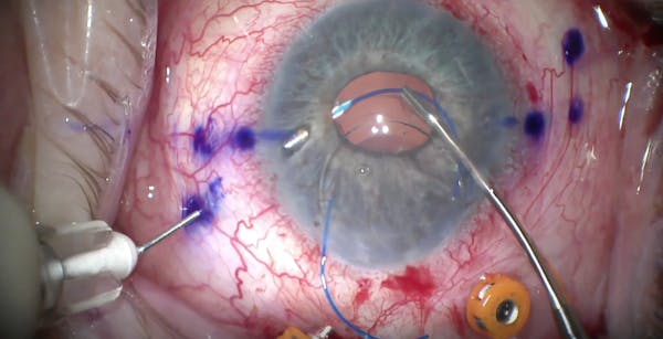 Intrascleral Haptic Fixation of an IOL thumbnail