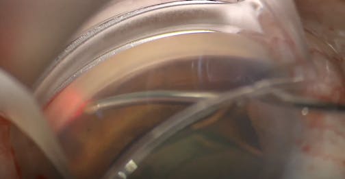 360-Degree GATT With Single-Handed iTrack