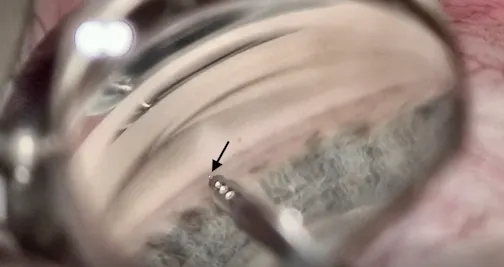 iDose Implantation: Pearls and Technique