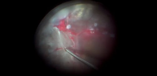 Severe Diabetic Retinopathy With Epiretinal Fibrous Tissue and Tractional Retinal Detachment
