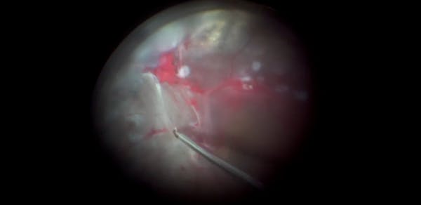 Severe Diabetic Retinopathy With Epiretinal Fibrous Tissue and Tractional Retinal Detachment thumbnail