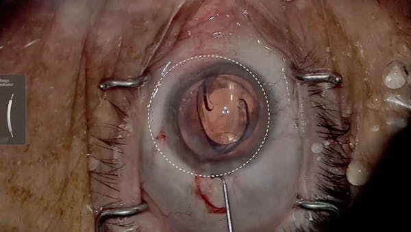 Post-Penetrating Keratoplasty Toric IOL Implantation thumbnail