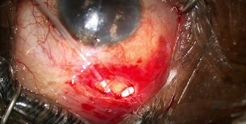ClearPath 'Taco' Technique - Eyetube