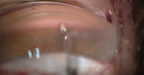 iDose Implantation - Eyetube