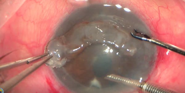 Re-DSAEK in Eye With History of Trabeculectomy and Cataract Surgery thumbnail