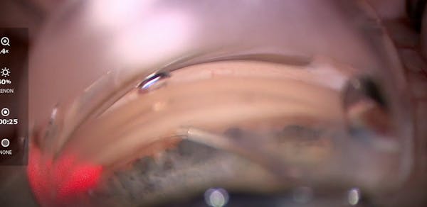 Breaking Herniations in the Canal thumbnail