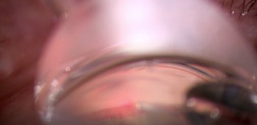 Viscodilation of the Collector System