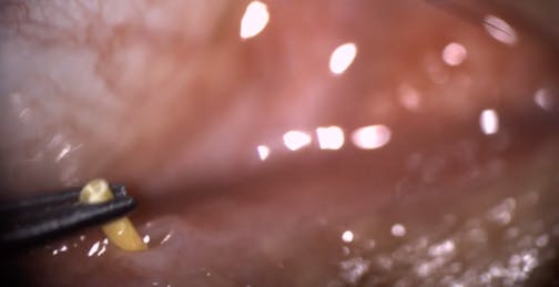 Treating Surface Inflammation With Dextenza