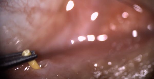 Treating Surface Inflammation With Dextenza thumbnail