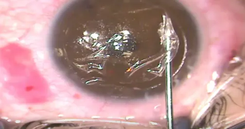 Tear During Flap Dissection