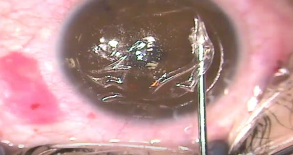 Tear During Flap Dissection thumbnail