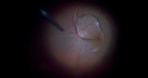 Vitrectomy With Stand-up Technique for Dislocated IOL thumbnail