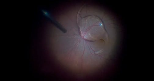 Vitrectomy With Stand-up Technique for Dislocated IOL