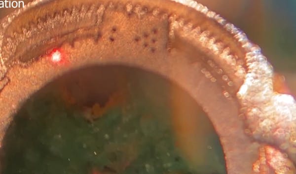 Novel Thermomechanical Adjustable IOL thumbnail