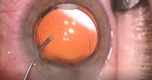 Capsular Bag: A New Site for Drug Delivery thumbnail