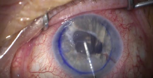 DMEK With Artificial Implant