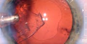Understanding Posterior Capsule Behavior