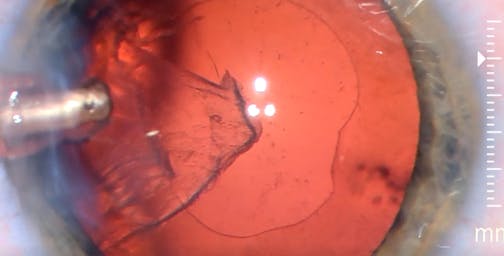 Understanding Posterior Capsule Behavior