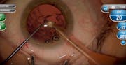 Anterior Vitreous Face Behavior