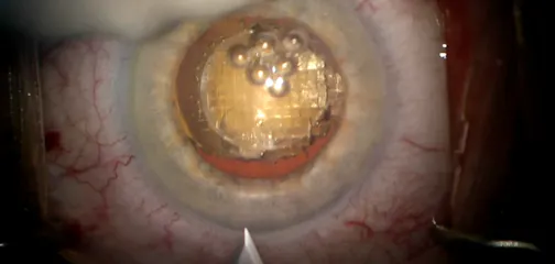 Treating Astigmatism With a Femtosecond Laser