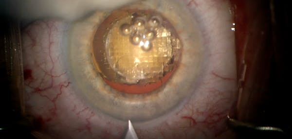 Treating Astigmatism With Femtosecond Laser thumbnail