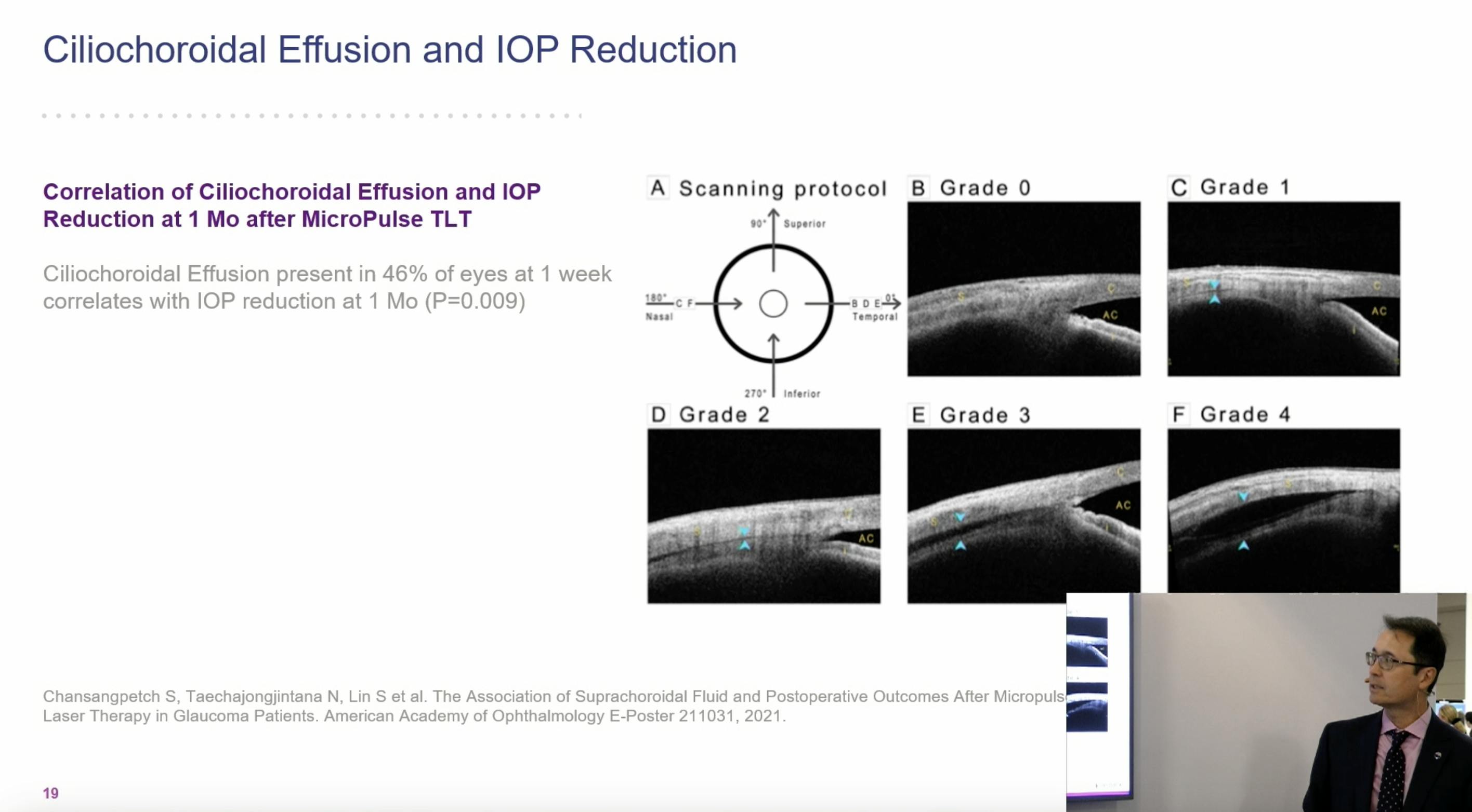 Iridex Academy A Primer on MicroPulse Transscleral Laser Therapy for