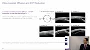 Iridex Academy: A Primer on MicroPulse Transscleral Laser Therapy for Glaucoma