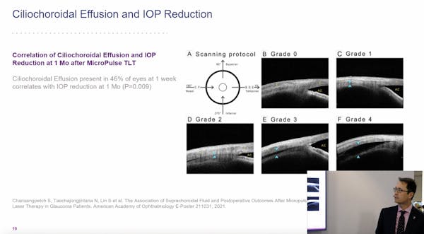 Iridex Academy: A Primer on MicroPulse Transscleral Laser Therapy for Glaucoma thumbnail