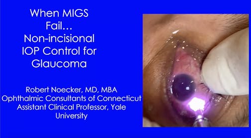 MicroPulse TLT: When MIGS Fails...Non-incisional IOP Control for Glaucoma