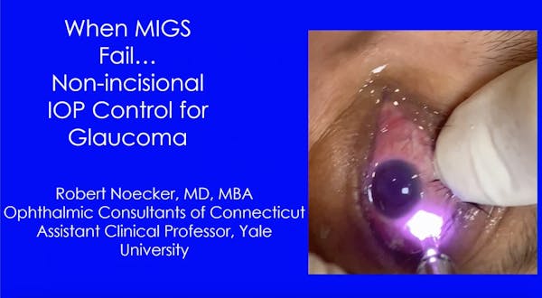 MicroPulse TLT: When MIGS Fails...Non-incisional IOP Control for Glaucoma thumbnail