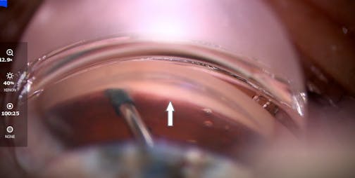 Strreamline Viscoelastic Canal Fluid Wave
