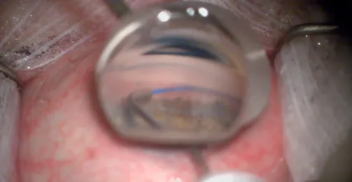 Repeat OMNI Goniotomy and Canaloplasty