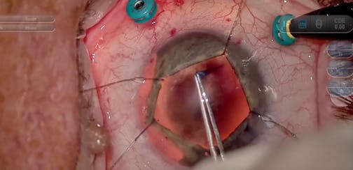 Chandelier Retroillumination in a Complex Cataract Extraction