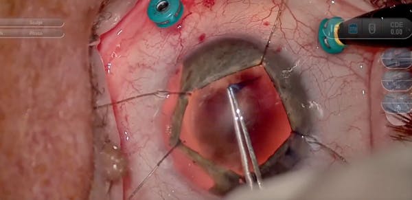 Chandelier Retroillumination in a Complex Cataract Extraction thumbnail