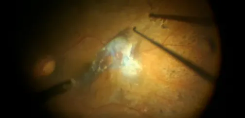 The Importance of Serial OCT Scans in Tractional Retinal Detachment