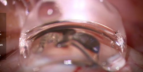 iTrack Advance With iStent Infinite for Mild POAG