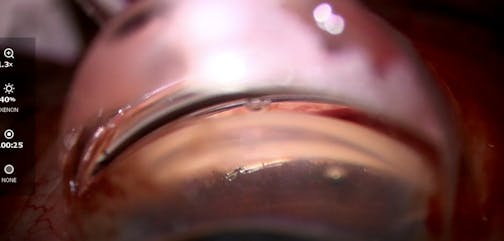 Hydrus Microstent Removal and Repositioning