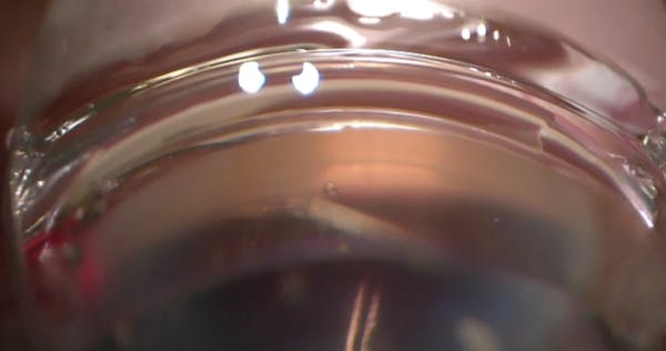 iTrack Canaloplasty With 90° Goniotomy thumbnail