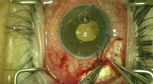 Sulcus Placement of Glaucoma Drainage Device