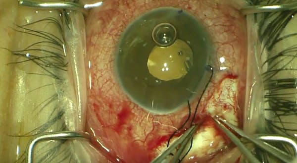 Sulcus Placement of Glaucoma Drainage Device thumbnail