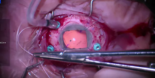IOL Fixation Using Gore-Tex Four-Point Fixation of a Single Piece IOL