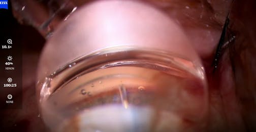 Stand Alone Streamline and iStent Infinite