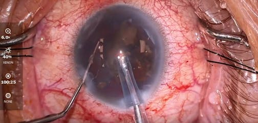 Multiple Technologies to Manage a Dense Cataract and Glaucoma