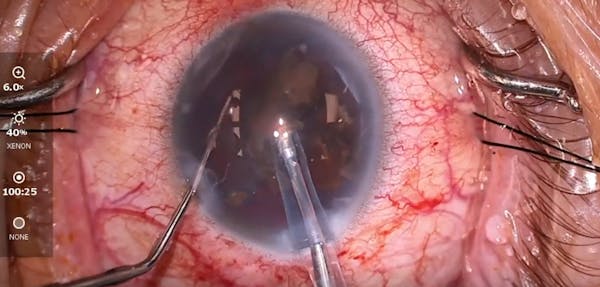 Multiple Technologies to Manage a Dense Cataract and Glaucoma thumbnail