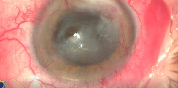 Concurrent Penetrating Keratoplasty and Cataract Extraction in Eye With Descemetocel and Acute Corneal Perforation thumbnail