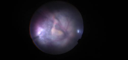 Surgery for Stage 3B Coats Disease