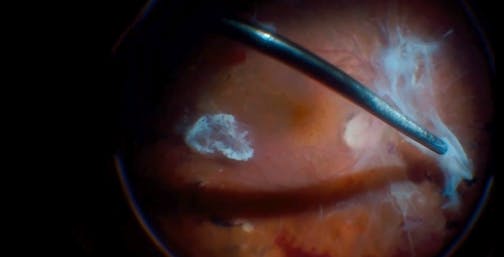 Vitrectomy for Severe Diabetic Retinopathy and Tractional Retinal Detachment