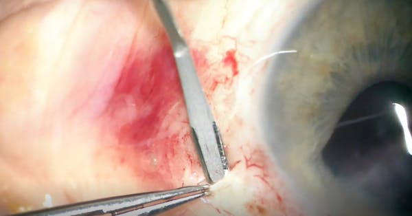 Modified Carlevale Technique: No Flaps, No Extra Sclerotomies, No Scleral Sutures thumbnail